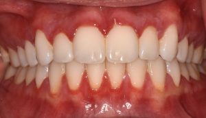ANUG – A sudden, painful gum infection with “punched-out” gums. Gingivitis, bleeding gums